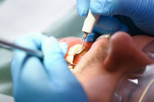 Best Emergency Wisdom Teeth Removal in Delavan, WI